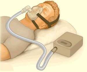 CPap and BiPap medical devices clinical biomedical engineering operation principle stuart gray south africa clinicalengineering
